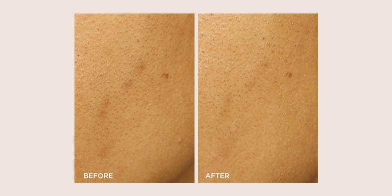 In Article How To Use Niacinamide And Retinol ExfoliantPeel